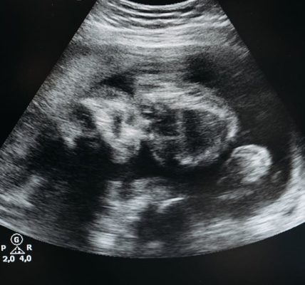 découvrez le fascinant processus du développement fœtal, de la conception à la naissance. informez-vous sur chaque étape cruciale de la gestation, les changements clés et l'impact sur la santé du futur bébé.